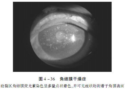 角结膜干燥症