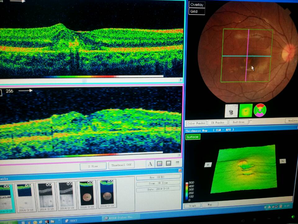 右眼的oct扫描结果,黄斑区有明显的灼伤痕迹
