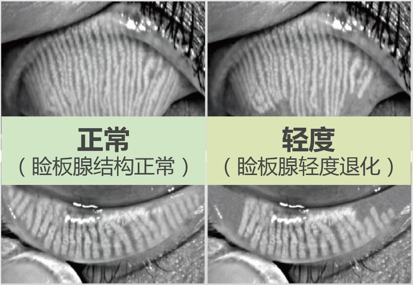 眼睛干到疼?睑板腺,了解一下